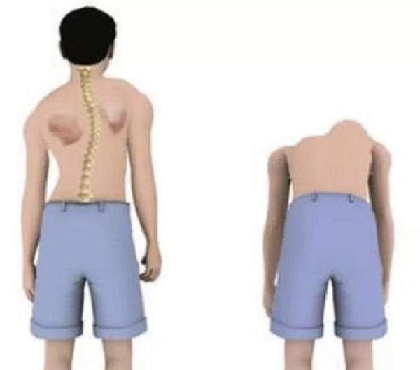 青少年脊柱健康 青少年脊柱健康