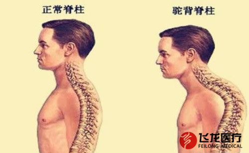脊柱健康，不向生活“低頭”