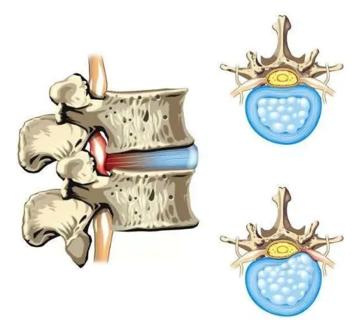 椎間盤解剖 椎間盤解剖