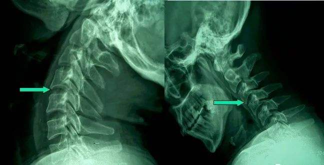 椎體緣骨贅形成 椎體緣骨贅形成