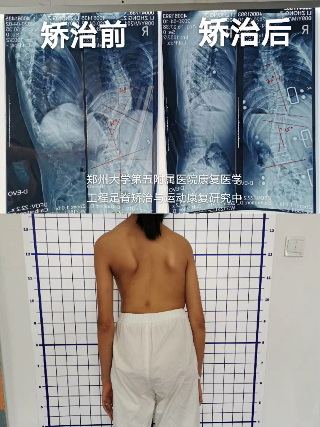 脊柱側(cè)彎治療 脊柱側(cè)彎治療